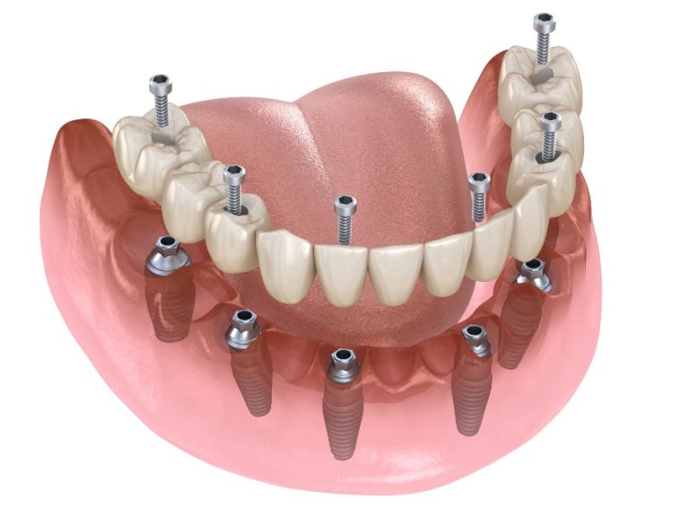 What Are Those Things In the Dentist’s OfficeUna Guida Ai Trattamenti Di Implantologia DentaleWhat Are Those Things In the Dentist’s Office