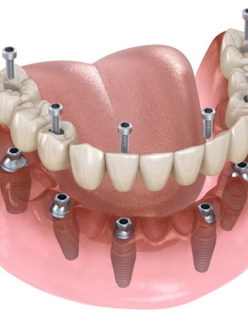 All-on-6 Dental Implants