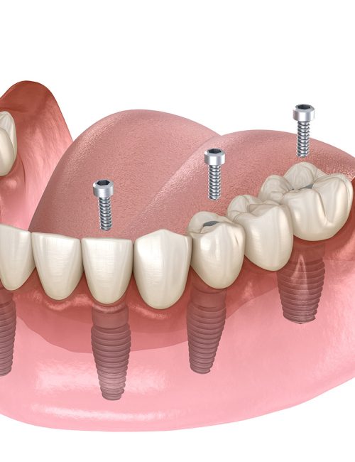 Mandibular prosthesis All on 4 system supported by implants, screw fixation. Medically accurate 3D illustration of dental concept