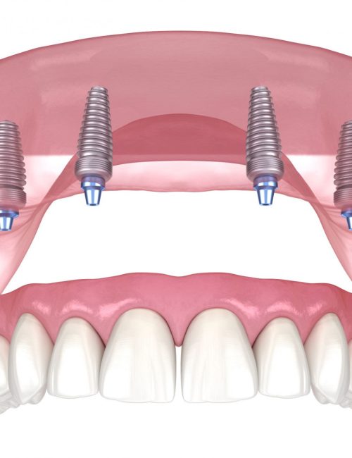 all-on-4-dental-implants