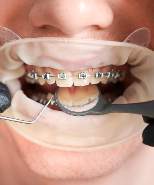 Macro photography of man's mouth with metal braces and cheek retractor. Dentist's hands in rubber gloves making teeth check up with dental tools. Cropped image. Top view. Oral hygiene concept