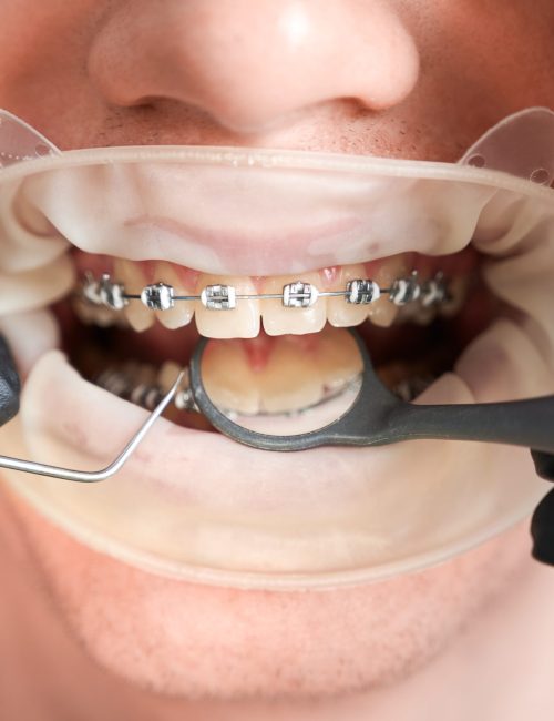 Macro photography of man's mouth with metal braces and cheek retractor. Dentist's hands in rubber gloves making teeth check up with dental tools. Cropped image. Top view. Oral hygiene concept